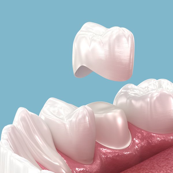 Dental Crowns What To Expect Before During And After The Procedure