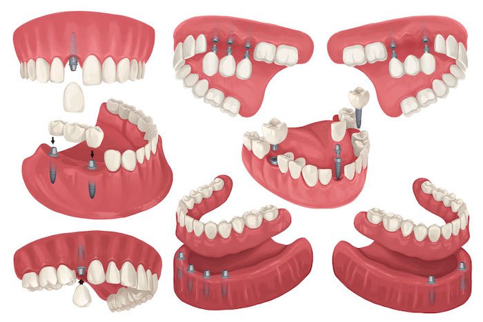 Types of Dental Implants.jpg