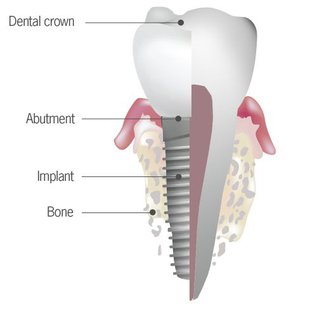 Understanding Dental Implants.jpg