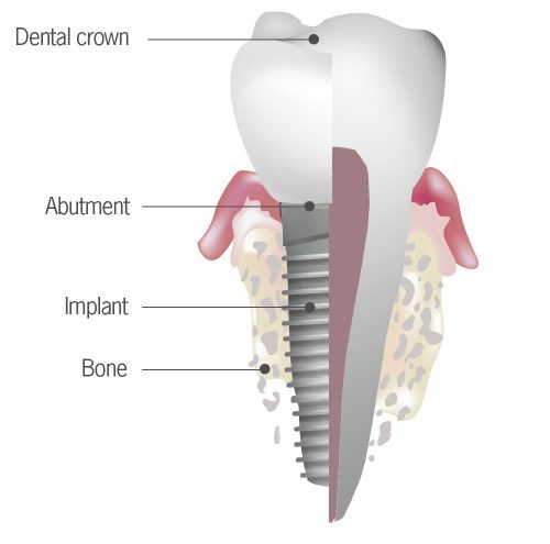 Understanding Dental Implants.jpg