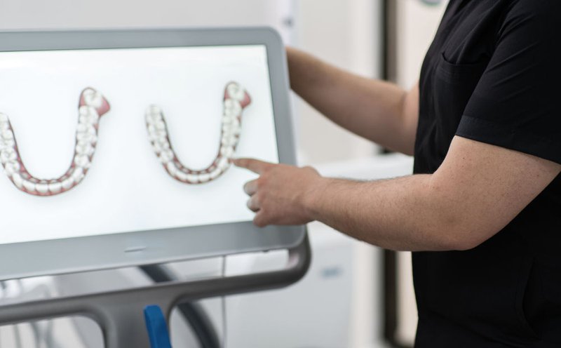 Who Is the iTero Invisalign Process Right For?