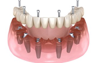 Dentist demonstrating an All-on-X full-arch dental implant restoration with a digital implant-supported prosthesis.