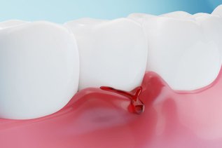 Bleeding gums between teeth when brushing