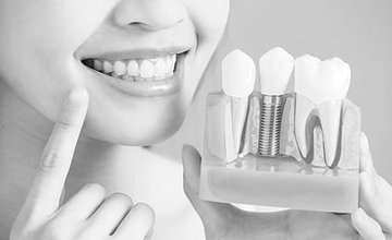 dental-implants.jpg