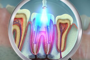 Dentist performing root canal therapy on infected tooth