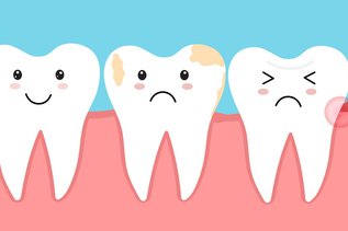 Illustration showing plaque buildup and enamel damage leading to tooth decay