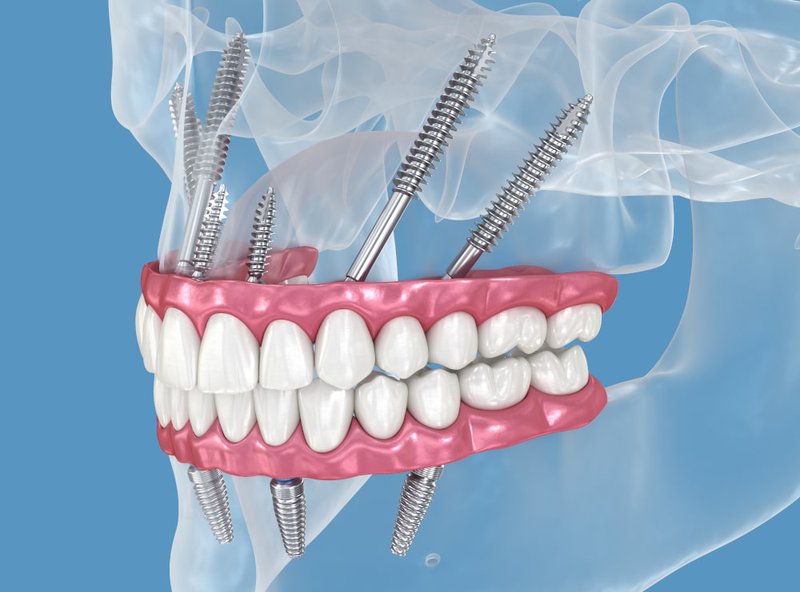 Clinical image of zygomatic dental implant anchoring to the cheekbone